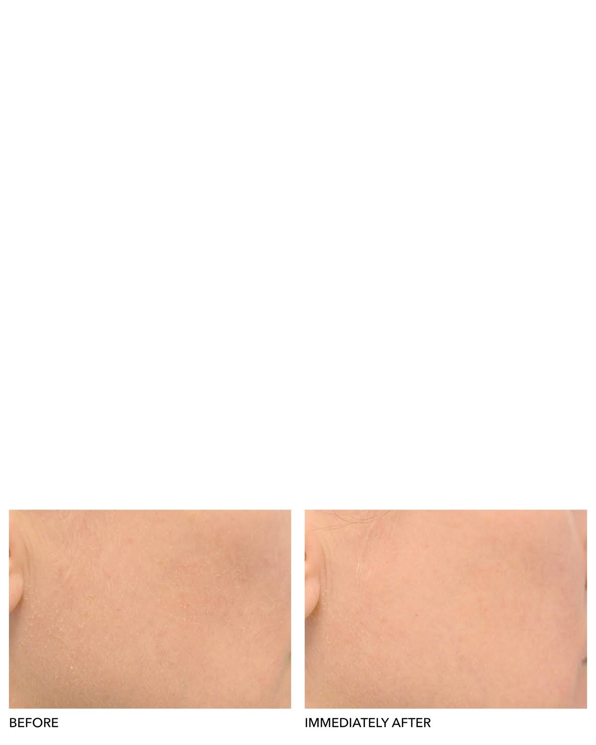 Clinical Grade Resurfacing Liquid Peel F17372