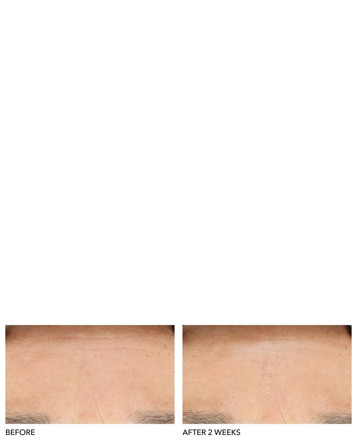 Clinical Grade Resurfacing Liquid Peel F17372